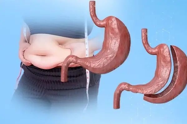 Obezite Cerrahisinin Riskleri ve Komplikasyonları