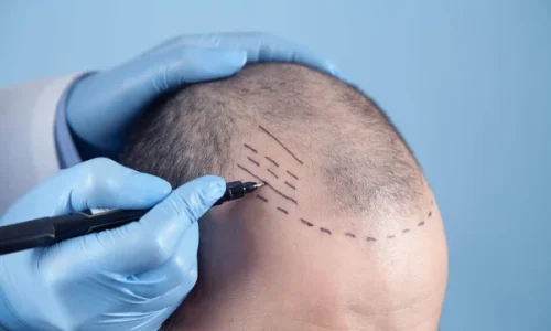 Hair Transplant