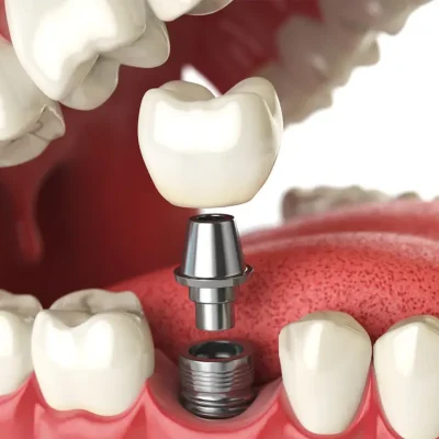 dental implant